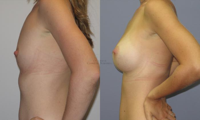 Before & After Breast Augmentation Case 32 View #2 View in St. Louis, MO