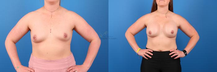 Before and After Breast Augmentation Sarhaddi