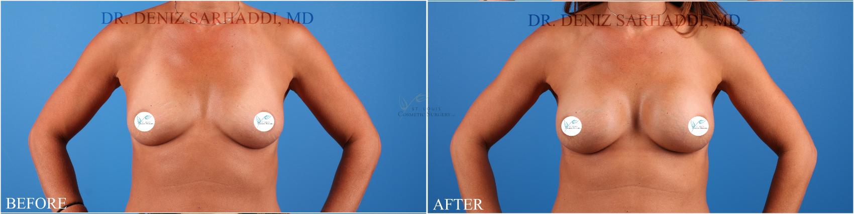 Before & After Breast Augmentation Case 338 Front View in St. Louis, MO