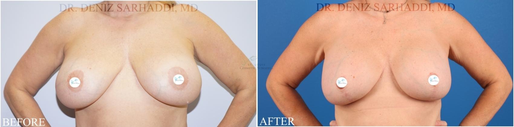 Before & After Breast Lift Case 339 Front View in St. Louis, MO