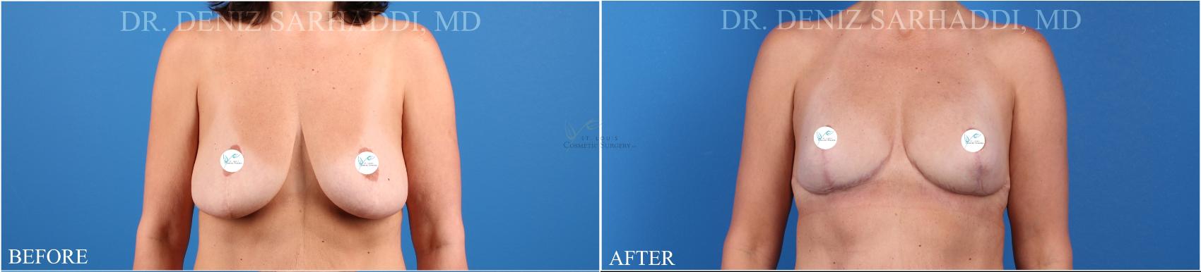 Before & After Breast Augmentation Case 340 Front View in St. Louis, MO