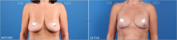 Before & After Breast Lift Case 340 Front View in St. Louis, MO