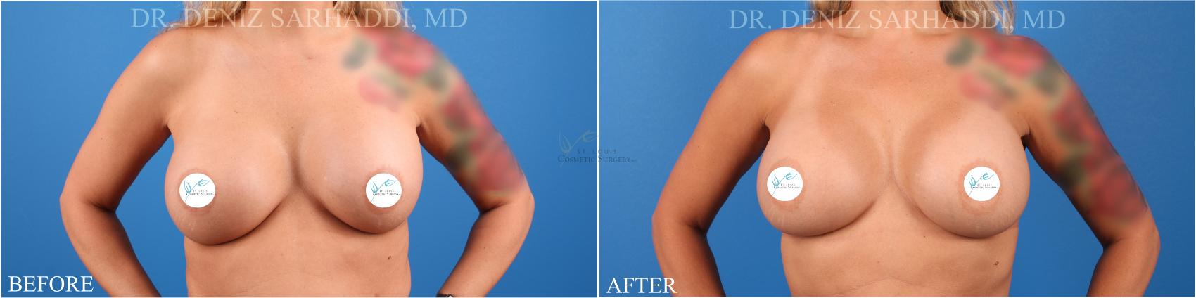 Before & After Breast Augmentation Case 341 Front View in St. Louis, MO