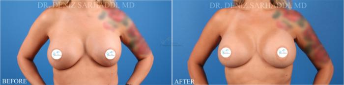 Before & After Breast Augmentation Case 341 Front View in St. Louis, MO