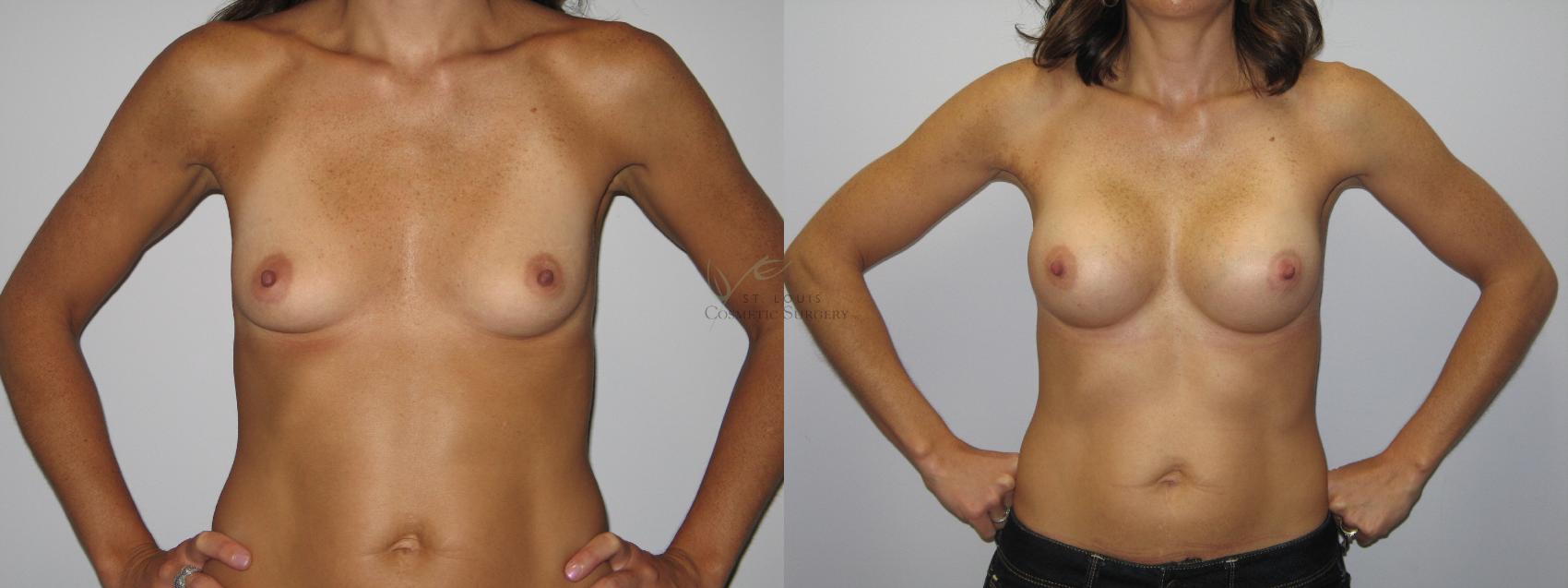 Before & After Breast Augmentation Case 35 View #1 View in St. Louis, MO