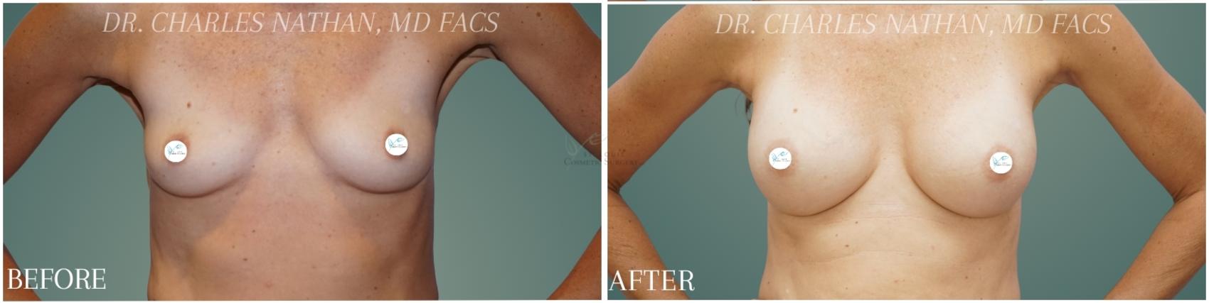 Before & After Breast Augmentation Case 353 Front View in St. Louis, MO