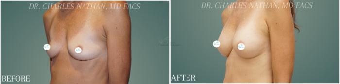 Before & After Breast Augmentation Case 353 Right Oblique View in St. Louis, MO