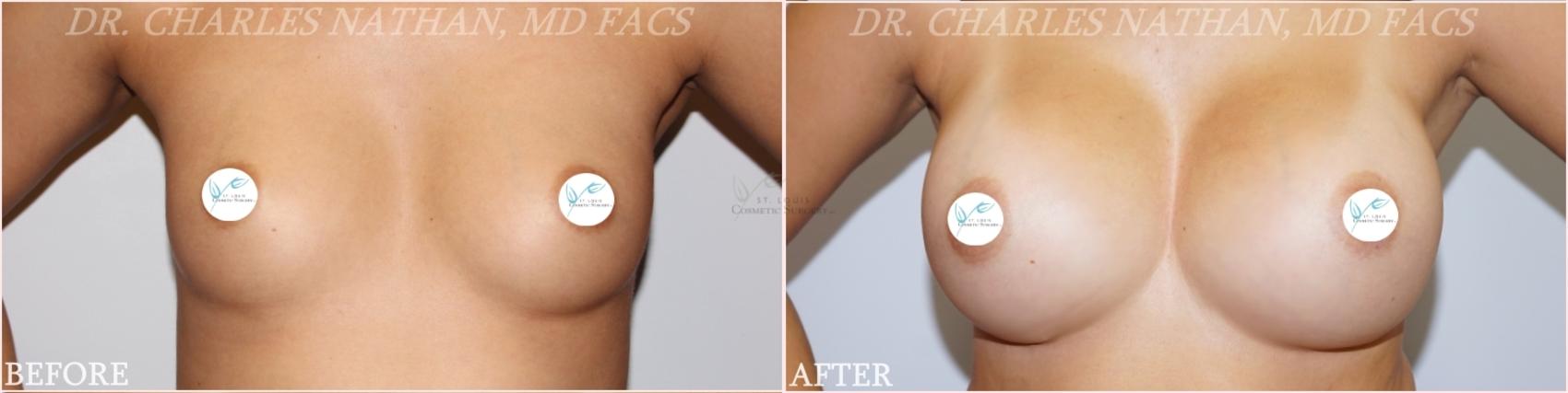 Before & After Breast Augmentation Case 355 Front View in St. Louis, MO