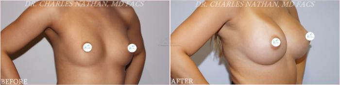 Before & After Breast Augmentation Case 355 Left Oblique View in St. Louis, MO