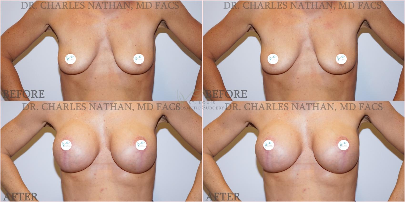 Before & After Breast Augmentation Case 356 Front View in St. Louis, MO