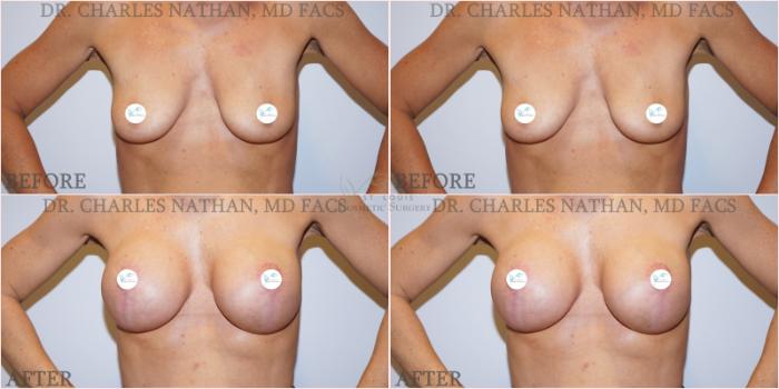 Before & After Breast Augmentation Case 356 Front View in St. Louis, MO