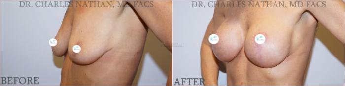 Before & After Breast Augmentation Case 356 Right Oblique View in St. Louis, MO