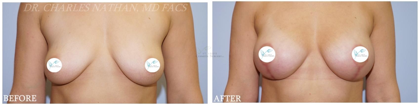 Before & After Breast Augmentation Case 359 Front View in St. Louis, MO