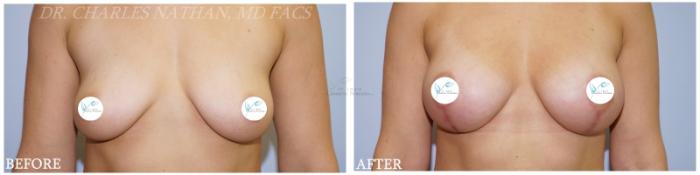 Before & After Breast Lift Case 359 Front View in St. Louis, MO