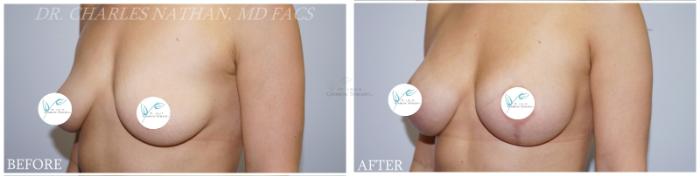 Before & After Breast Augmentation Case 359 Right Oblique View in St. Louis, MO