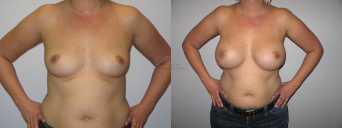 Before & After Breast Augmentation Case 36 View #1 View in St. Louis, MO
