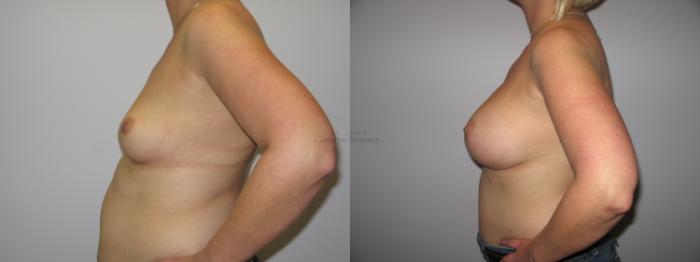 Before & After Breast Augmentation Case 36 View #2 View in St. Louis, MO