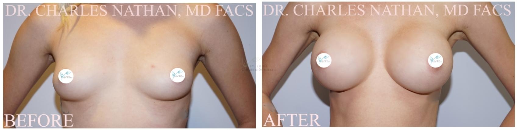 Before & After Breast Augmentation Case 360 Front View in St. Louis, MO