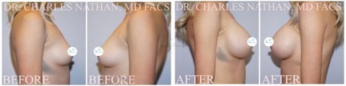 Before & After Breast Augmentation Case 360 Right Side View in St. Louis, MO