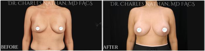 Before & After Breast Augmentation Case 362 Front View in St. Louis, MO