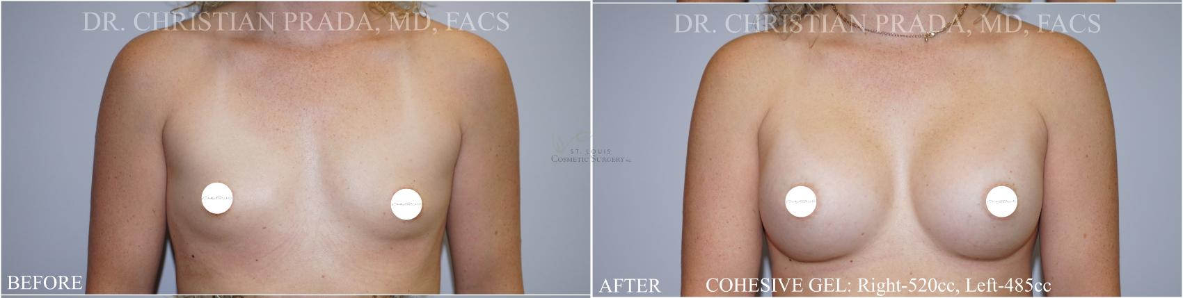 Before & After Breast Augmentation Case 364 Front View in St. Louis, MO