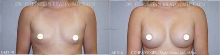 Before & After Breast Augmentation Case 364 Front View in St. Louis, MO