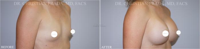 Before & After Breast Augmentation Case 364 Left Oblique View in St. Louis, MO