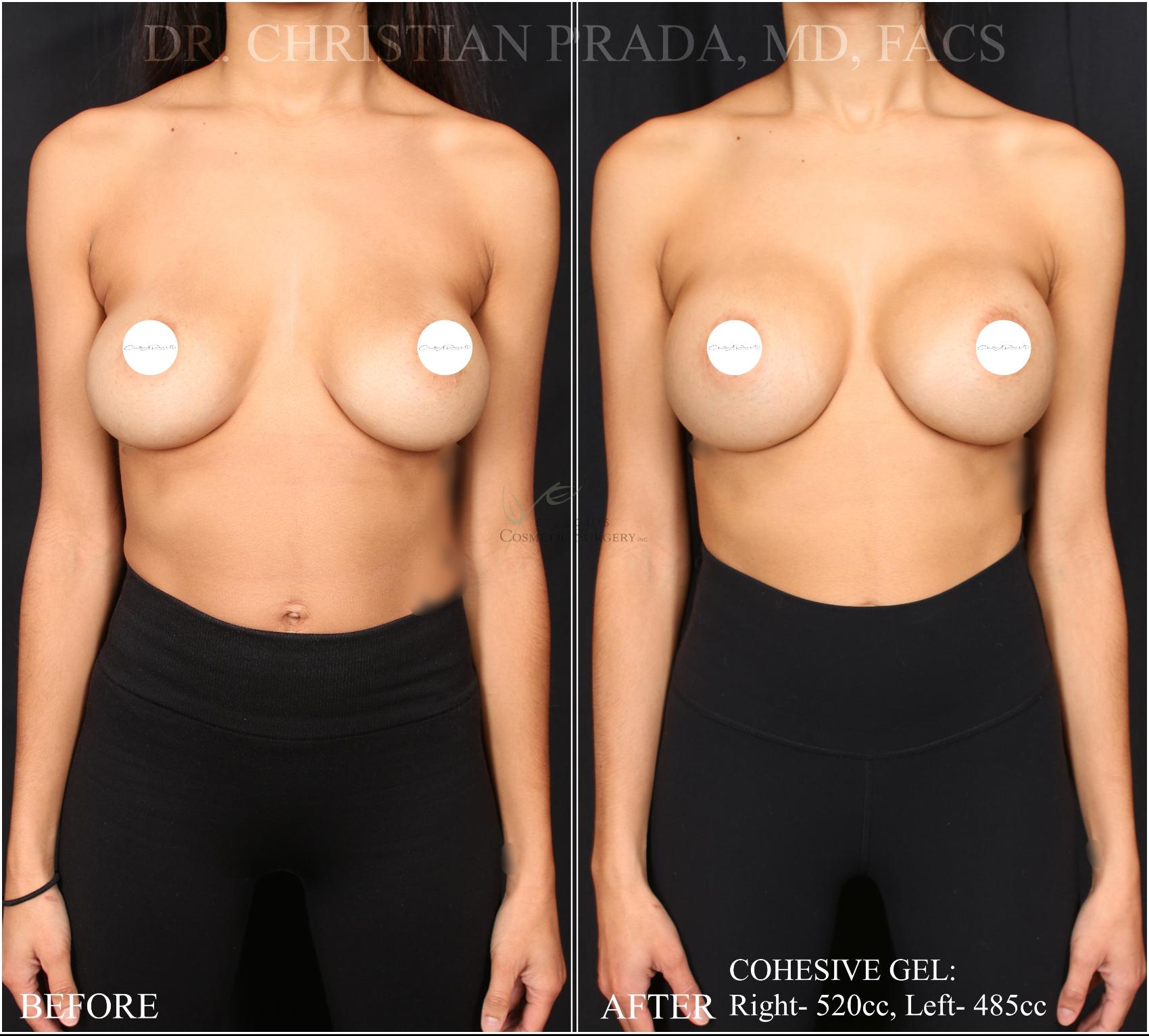 Before & After Breast Augmentation Case 365 Front View in St. Louis, MO