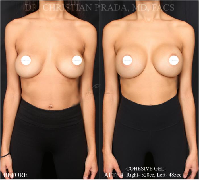 Before & After Breast Augmentation Case 365 Front View in St. Louis, MO