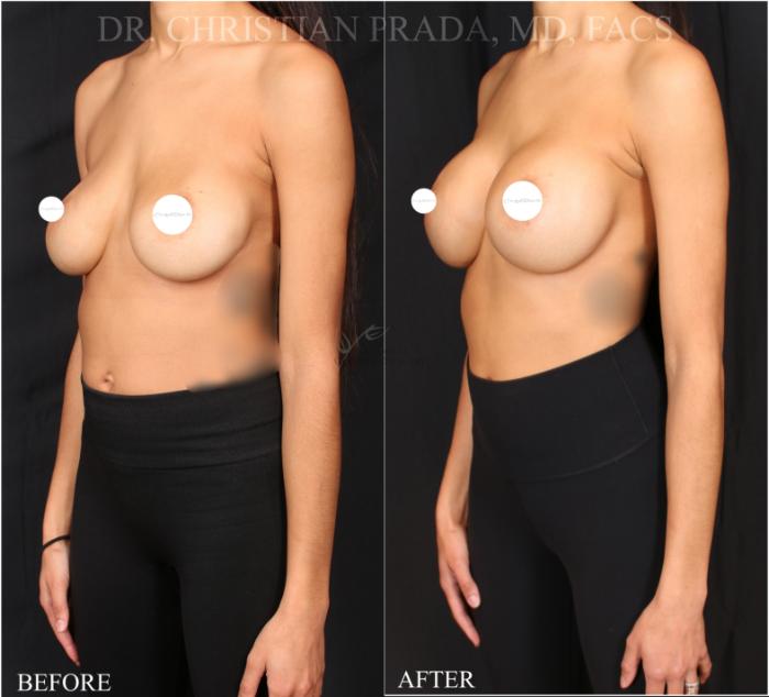 Before & After Breast Augmentation Case 365 Right Oblique View in St. Louis, MO