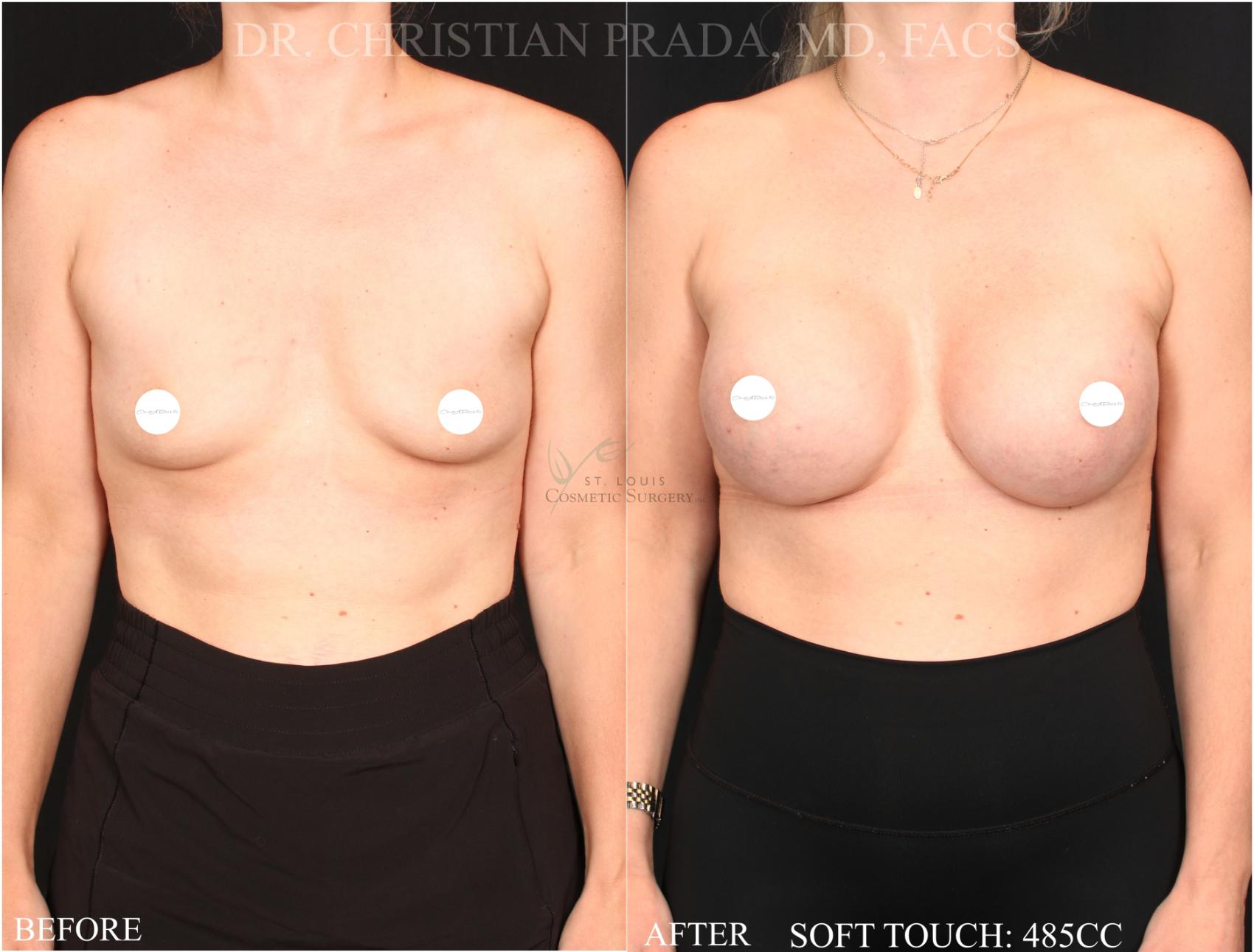 Before & After Breast Augmentation Case 366 Front View in St. Louis, MO