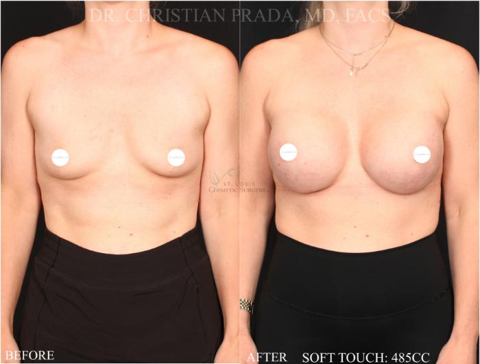 Before & After Breast Augmentation Case 366 Front View in St. Louis, MO