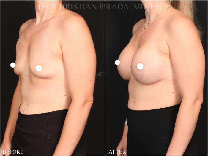 Before & After Breast Augmentation Case 366 Right Oblique View in St. Louis, MO