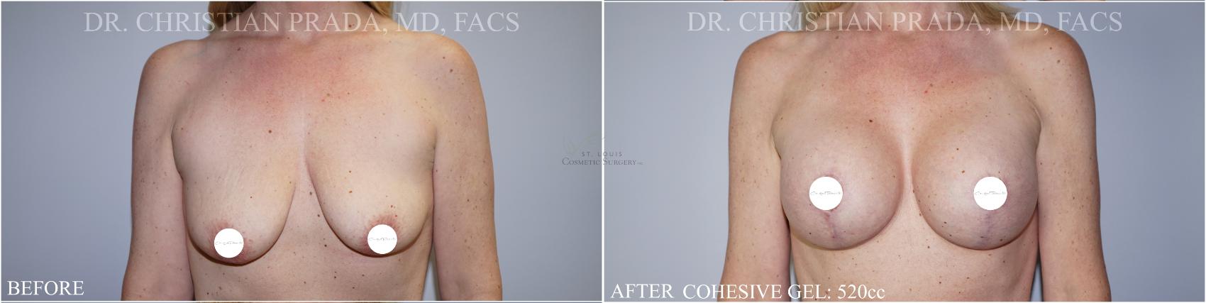 Before & After Breast Augmentation Case 367 Front View in St. Louis, MO