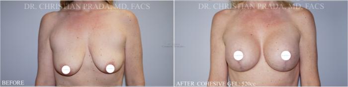 Before & After Breast Lift Case 367 Front View in St. Louis, MO