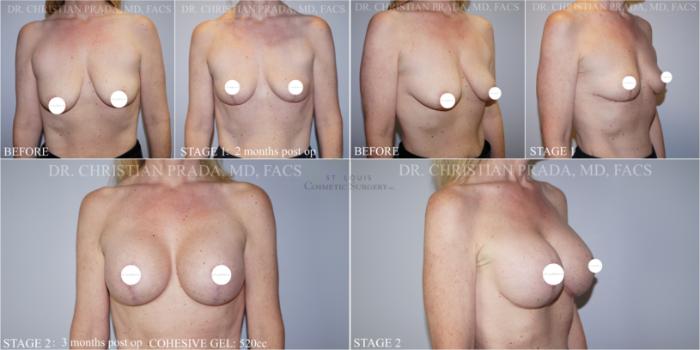 Before & After Breast Lift Case 367 Stage 1 and Stage 2 Progression View in St. Louis, MO