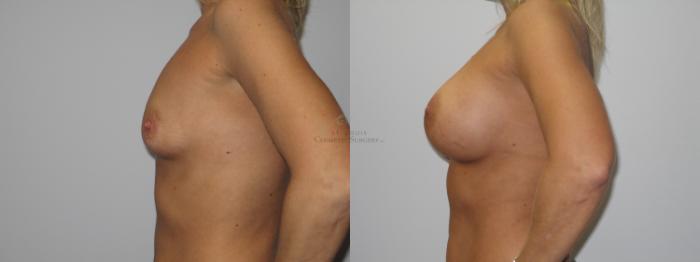 Before & After Breast Augmentation Case 37 View #2 View in St. Louis, MO