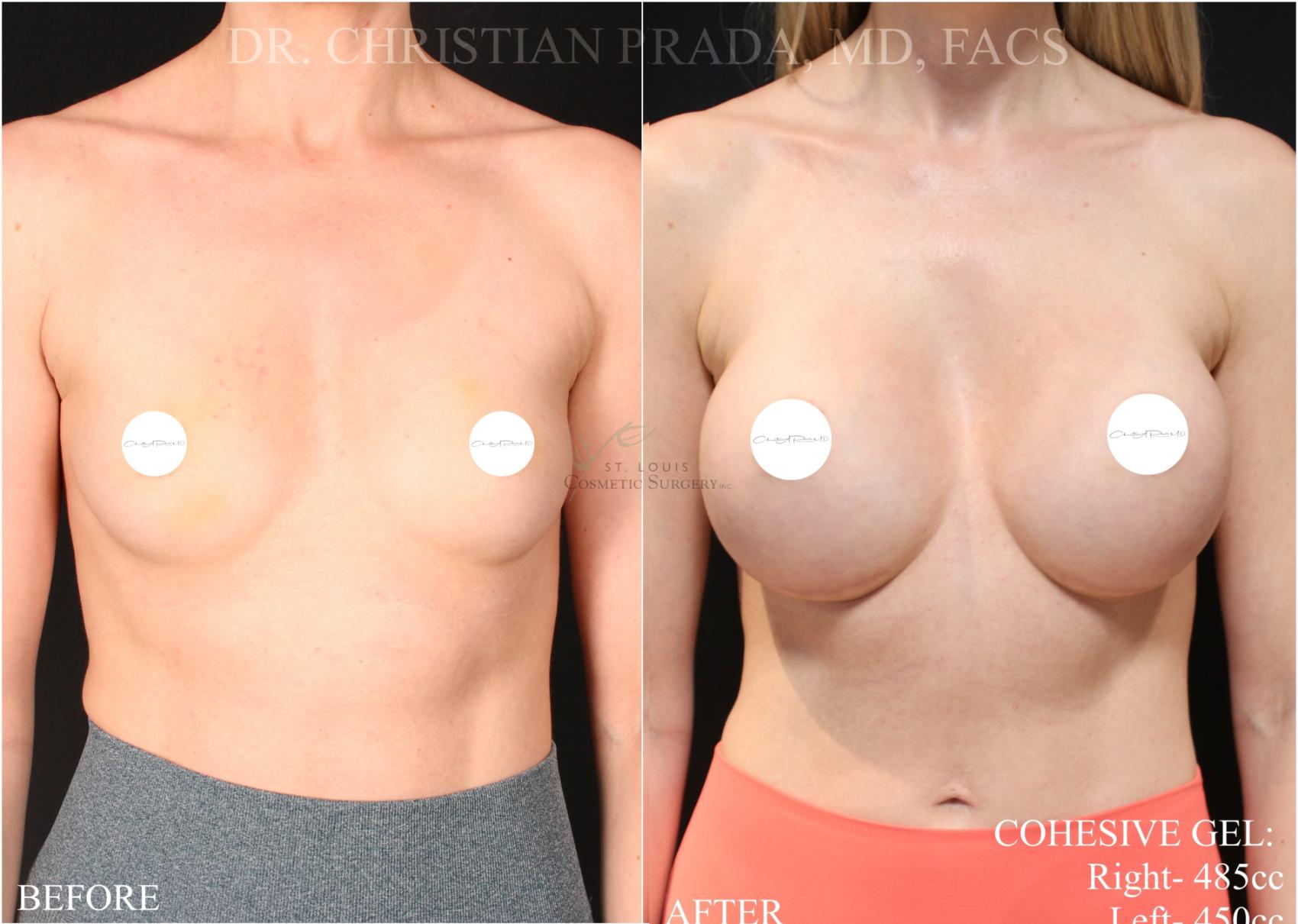 Before & After Breast Augmentation Case 374 Front View in St. Louis, MO