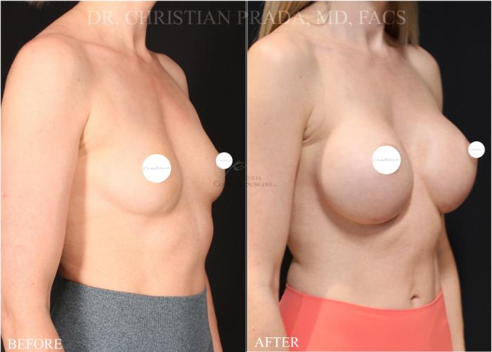 Before & After Breast Augmentation Case 374 Left Oblique View in St. Louis, MO