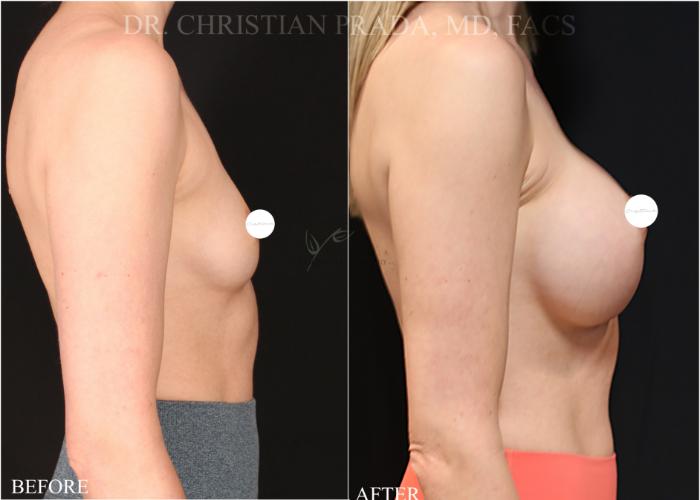 Before & After Breast Augmentation Case 374 Left Side View in St. Louis, MO