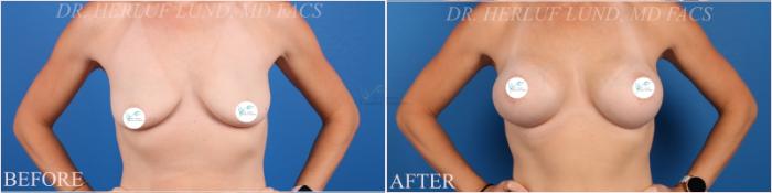 Before & After Breast Augmentation Case 375 Front View in St. Louis, MO