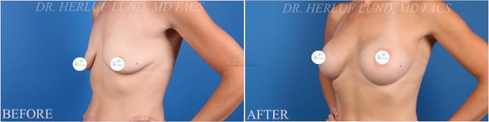 Before & After Breast Augmentation Case 375 Right Oblique View in St. Louis, MO