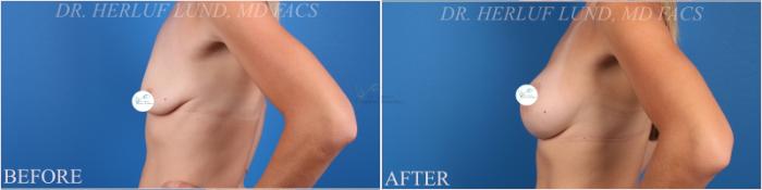 Before & After Breast Augmentation Case 375 Right Side View in St. Louis, MO