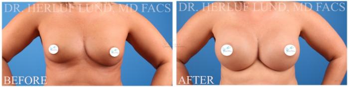 Before & After Breast Augmentation Case 376 Front View in St. Louis, MO