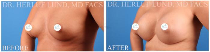 Before & After Breast Augmentation Case 376 Right Oblique View in St. Louis, MO