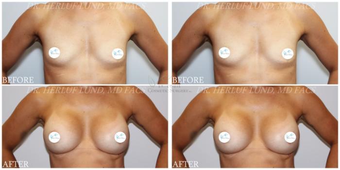 Before & After Breast Augmentation Case 381 Front View in St. Louis, MO