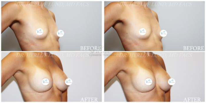 Before & After Breast Augmentation Case 381 Left Oblique View in St. Louis, MO