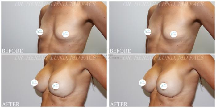 Before & After Breast Augmentation Case 381 Right Oblique View in St. Louis, MO