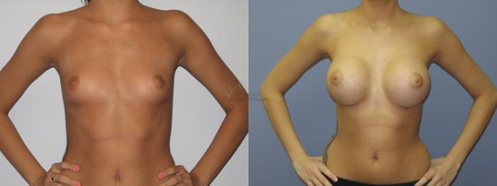 Before & After Breast Augmentation Case 39 View #1 View in St. Louis, MO