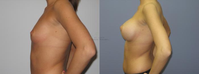 Before & After Breast Augmentation Case 39 View #2 View in St. Louis, MO
